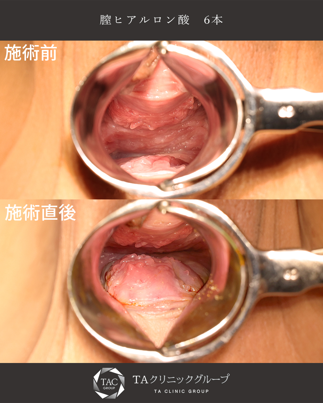 婦人科整形の症例写真で見る仕上がりとダウンタイム経過の全貌