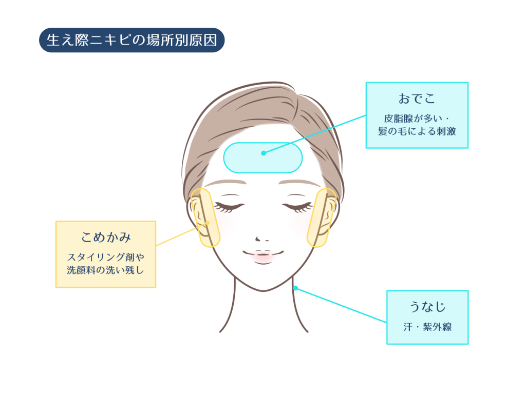 なぜ治らない？おでこ・生え際ニキビの真相と2026年最新の根本改善策