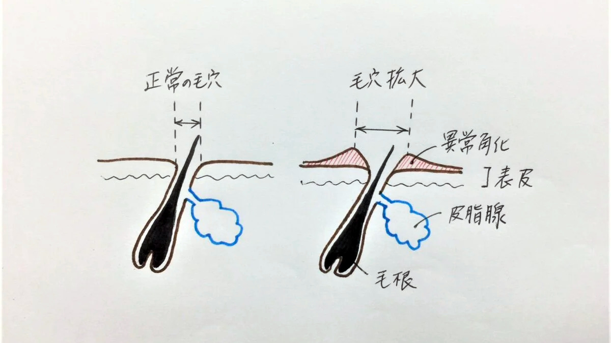 頑張る人ほど毛穴が目立つのはなぜ？隠れた理由と正しいケアを徹底解説