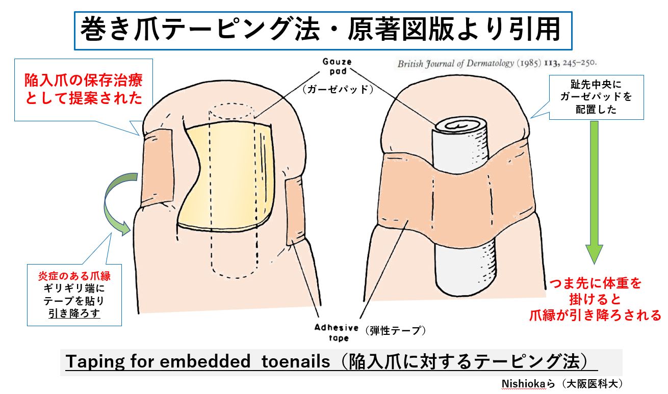 巻き爪テーピングの正しい貼り方と痛みを即緩和する極意【2026最新】