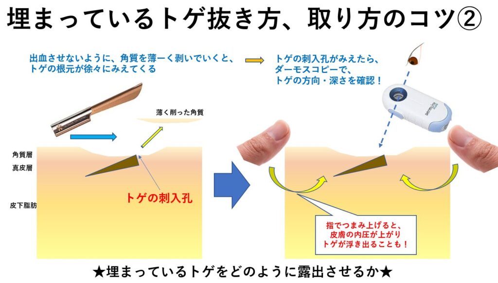 指のとげが抜けない時の安全な取り方と放置リスク・受診目安