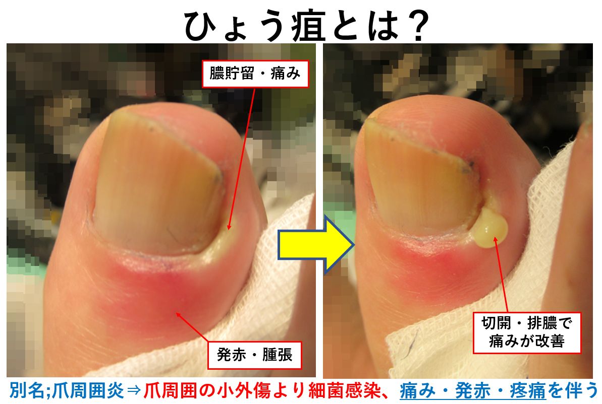 爪囲炎の痛みを即効で抑える治し方｜市販薬の選び方と皮膚科受診の基準