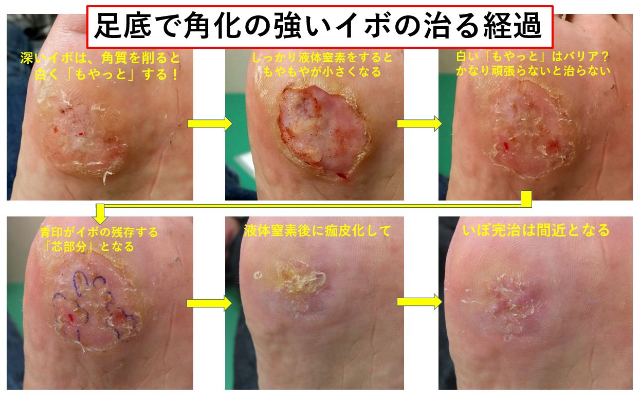 イボの液体窒素治療で取れるまでの経過と写真検証！完治期間と痛みの真相