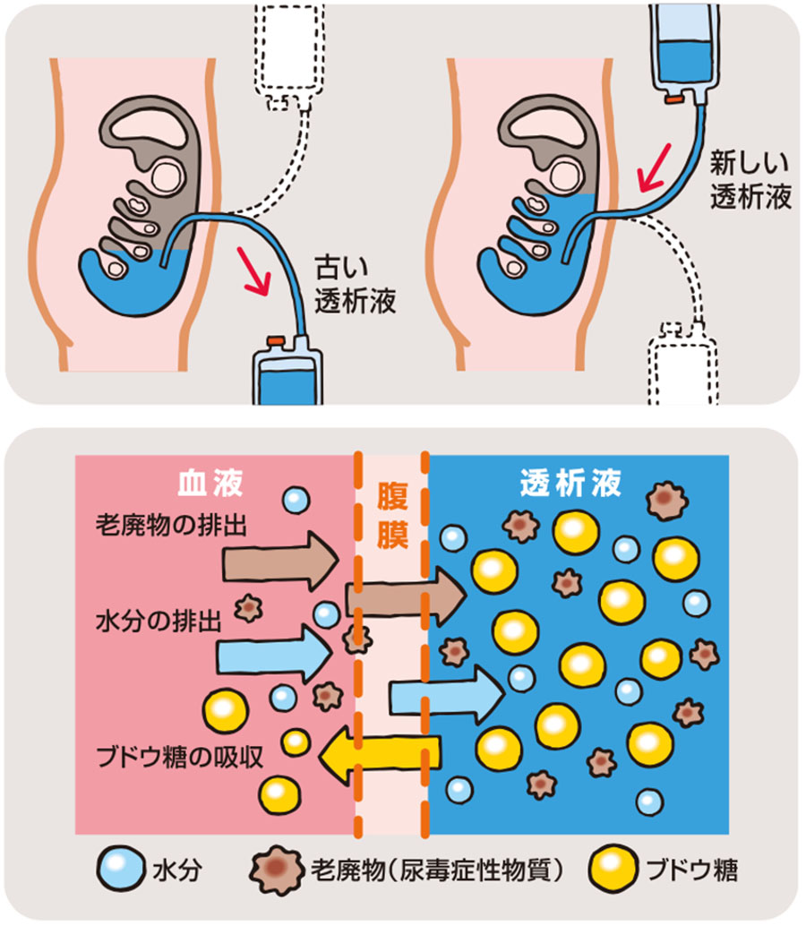 腹膜透析のやり方を徹底解説｜Capd・Apd手順と生活のコツ