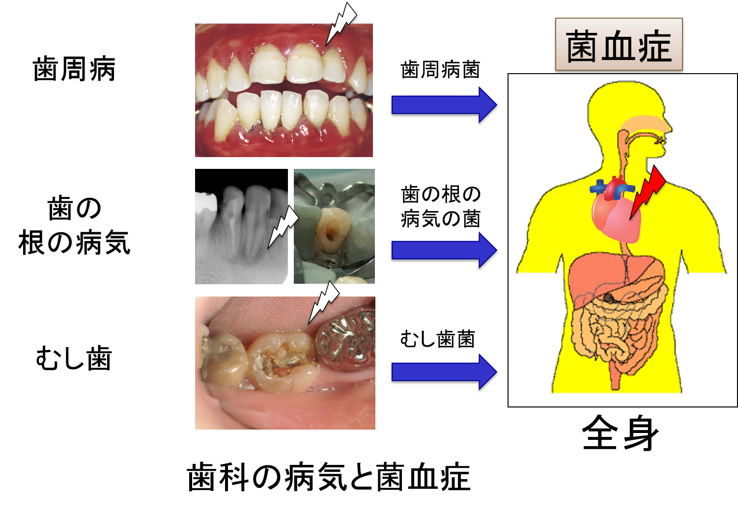 突然の悪寒と高熱は菌血症の兆候？敗血症との違いと危険な初期症状