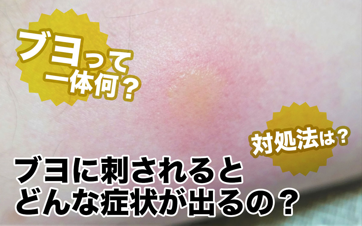 ブヨ虫刺されの激痛と腫れ！跡を残さない応急処置と市販薬の選び方