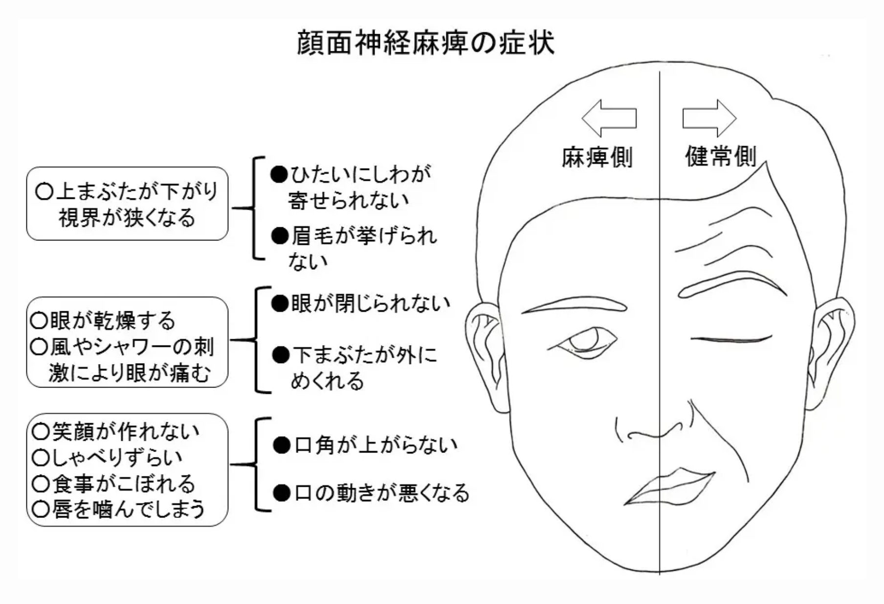 ラムゼイハント症候群の初期症状と完治率｜激痛・麻痺の真相と後遺症予防