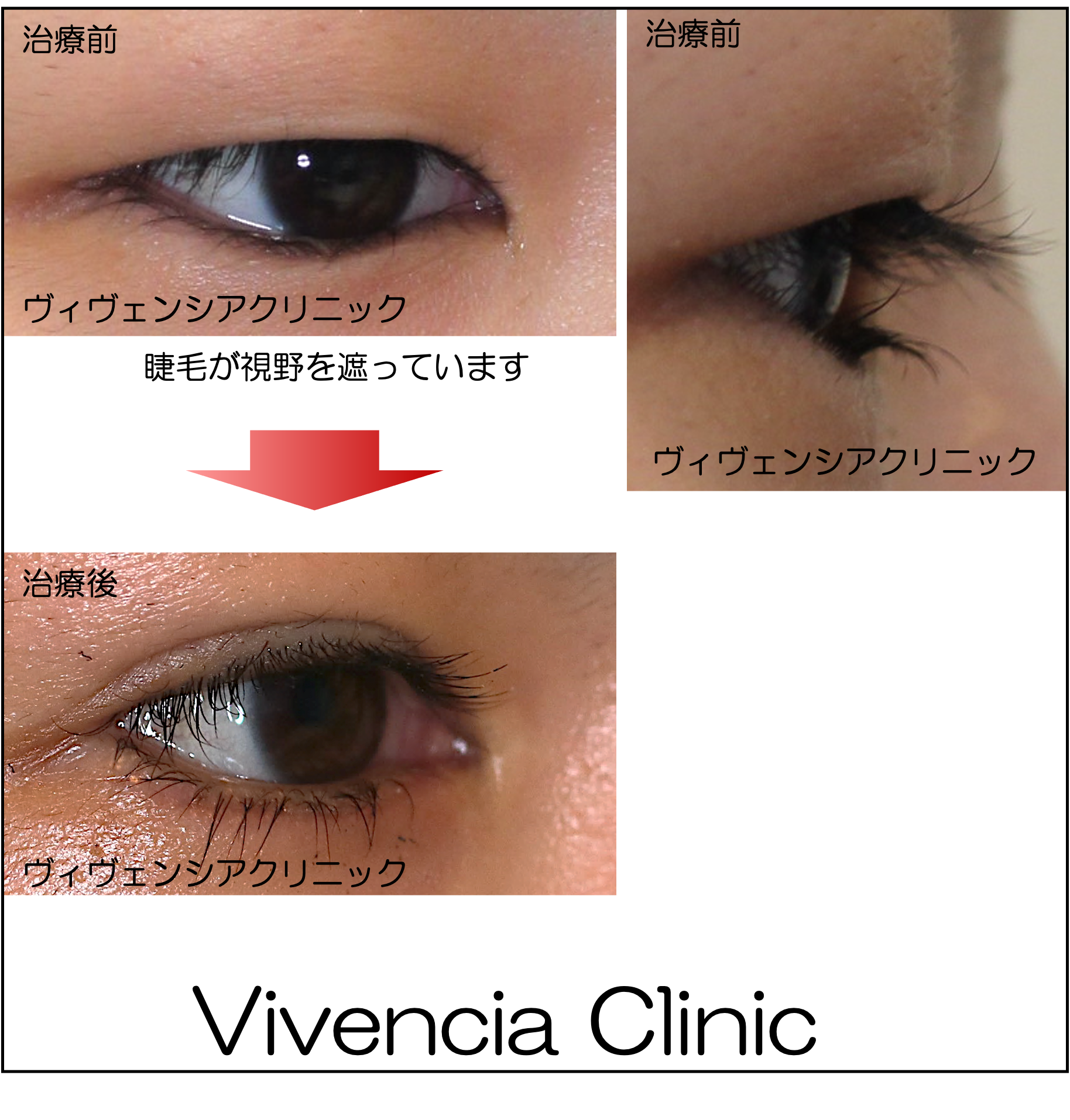 重い一重まぶたの原因と解消法！自力ケアから垢抜け術まで徹底解説