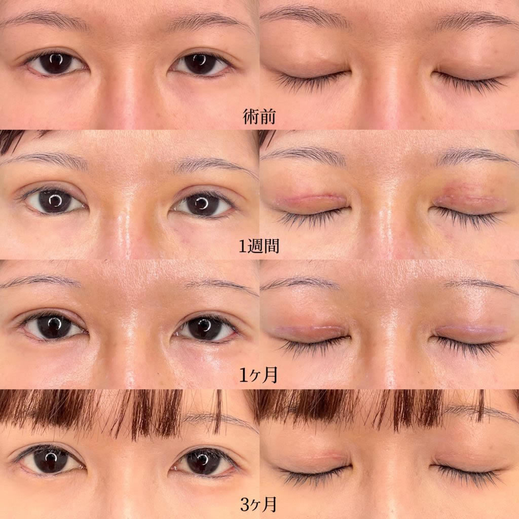 眼瞼下垂ダウンタイムの全貌！腫れのピークと仕事復帰の目安