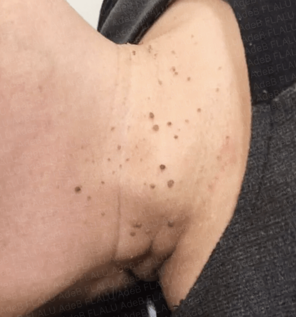 首周りのイボの原因と最新治療法｜皮膚科費用と自分で取るリスク