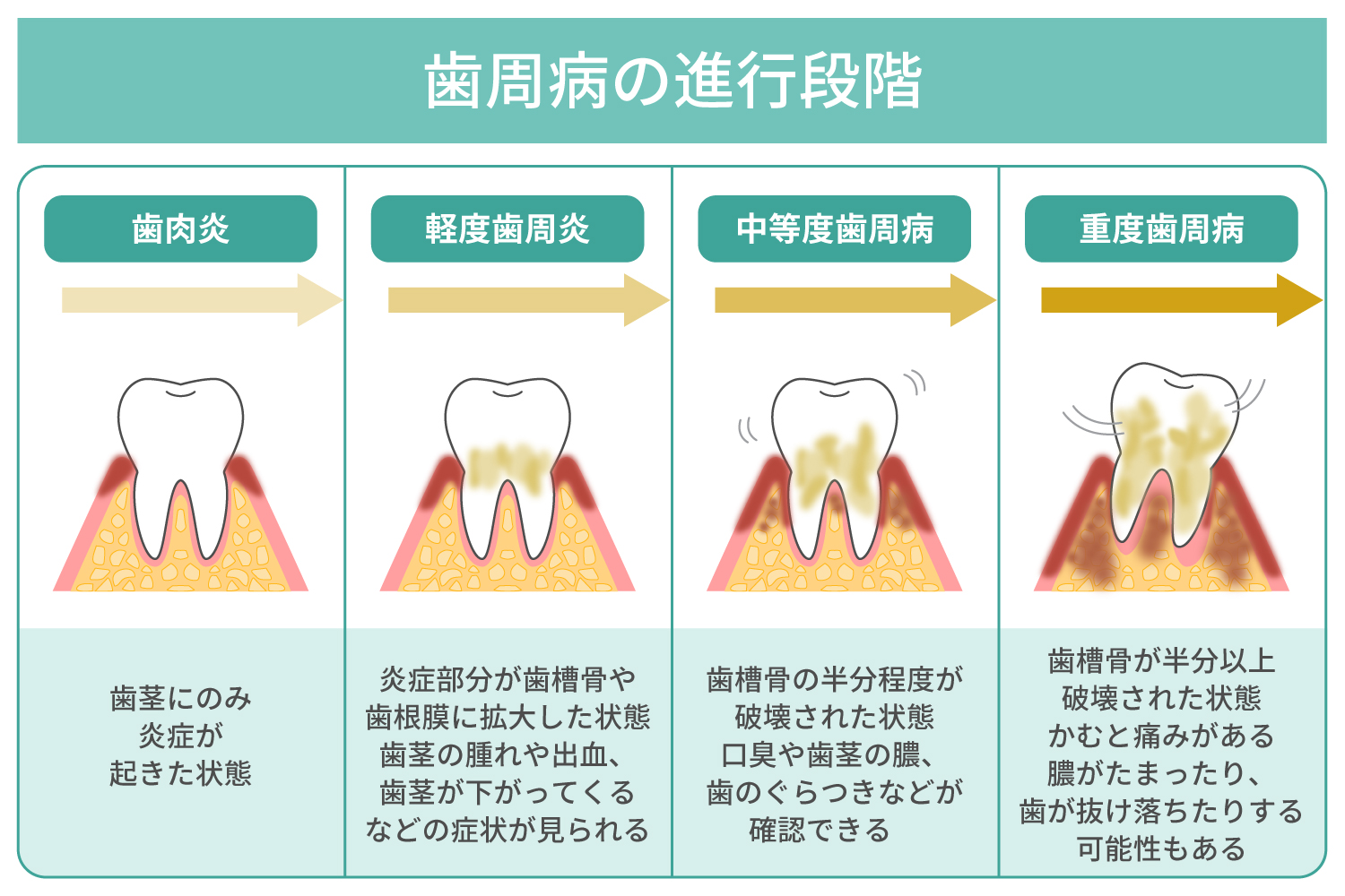 歯周病の手遅れ症状と抜歯の境界線！骨が溶ける最終警告の真実