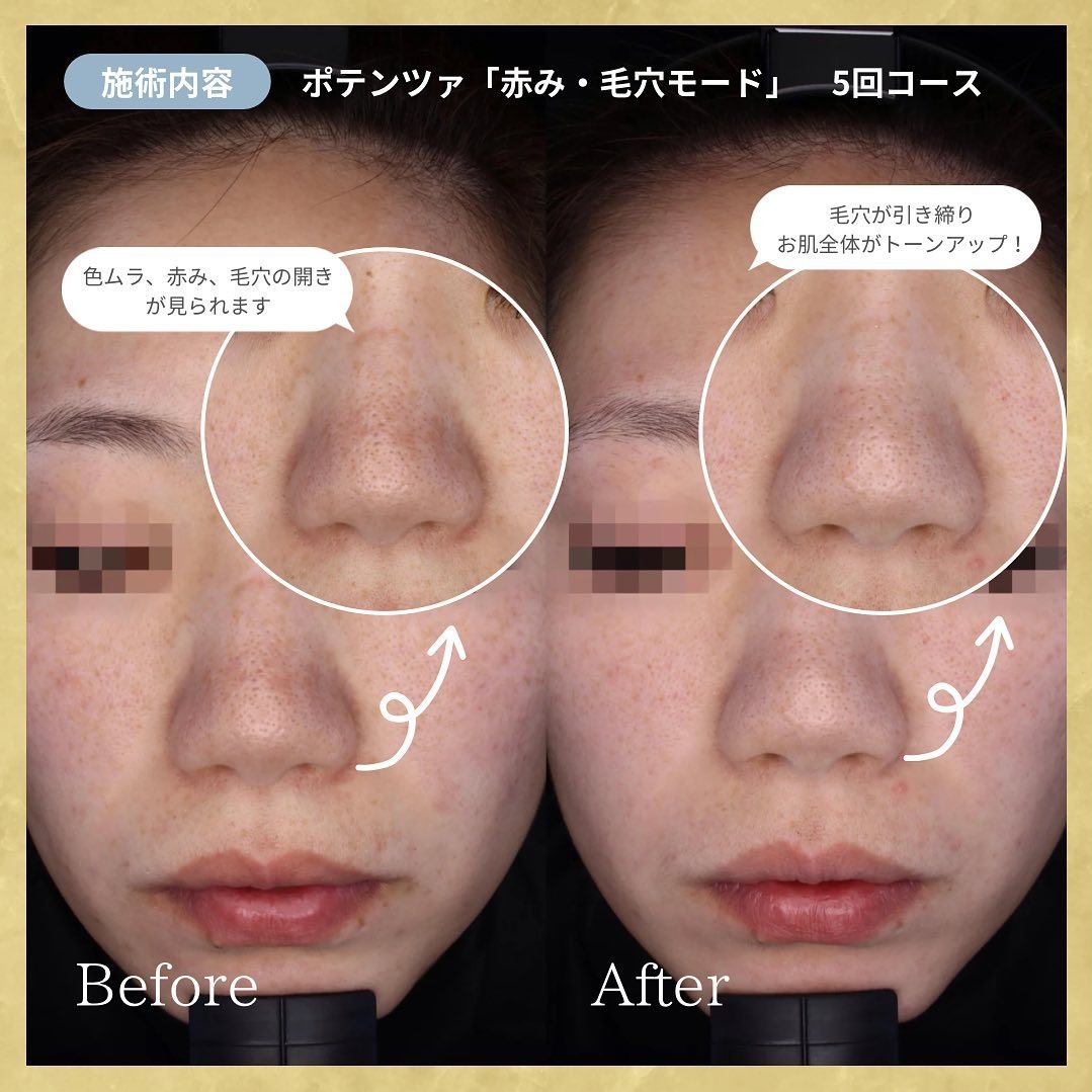 毛穴の開きを治す全真相！Ng習慣の罠と2026年最新治療を徹底解説