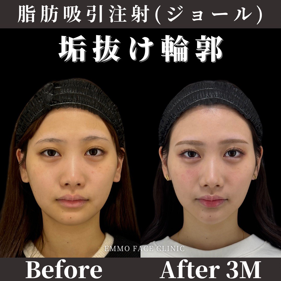 頬の肉を落とす最短ルート！原因別の劇的小顔メソッド徹底解剖