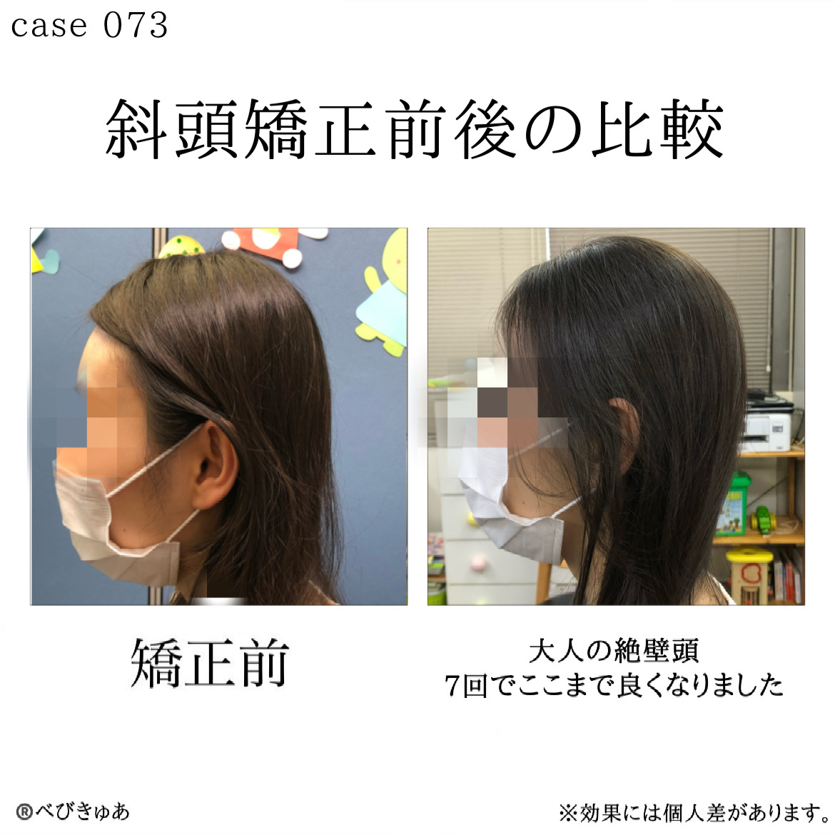 大人の絶壁頭は治る？原因の真相と後頭部を変える2026最新解決策