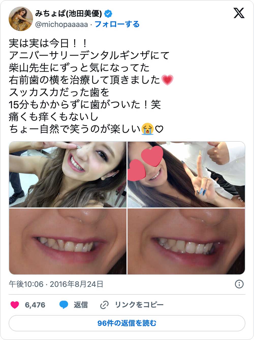 芸能人のオールセラミック事情｜白すぎる噂の真相と後悔しない全知識