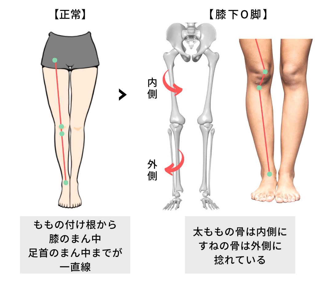 膝下O脚が治らない驚愕の理由！外張りを解消する2026年最新改善法