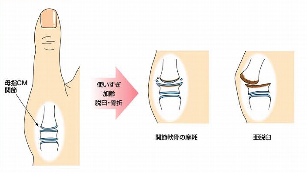 親指の爪の縦線は病気のサイン？黒い筋・凸凹の原因と見分け方