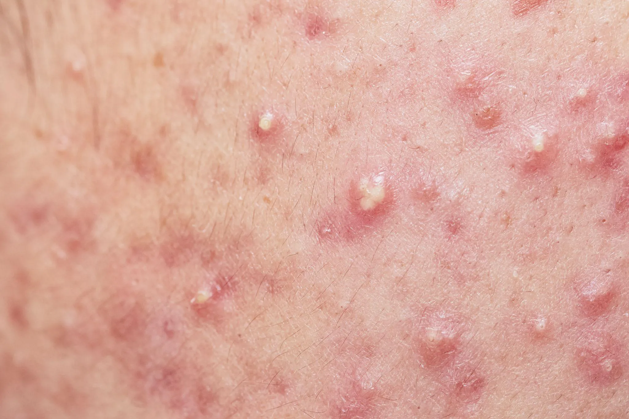 なぜ自分ばかり？粉瘤ができやすい人の共通点と再発を防ぐ根治策