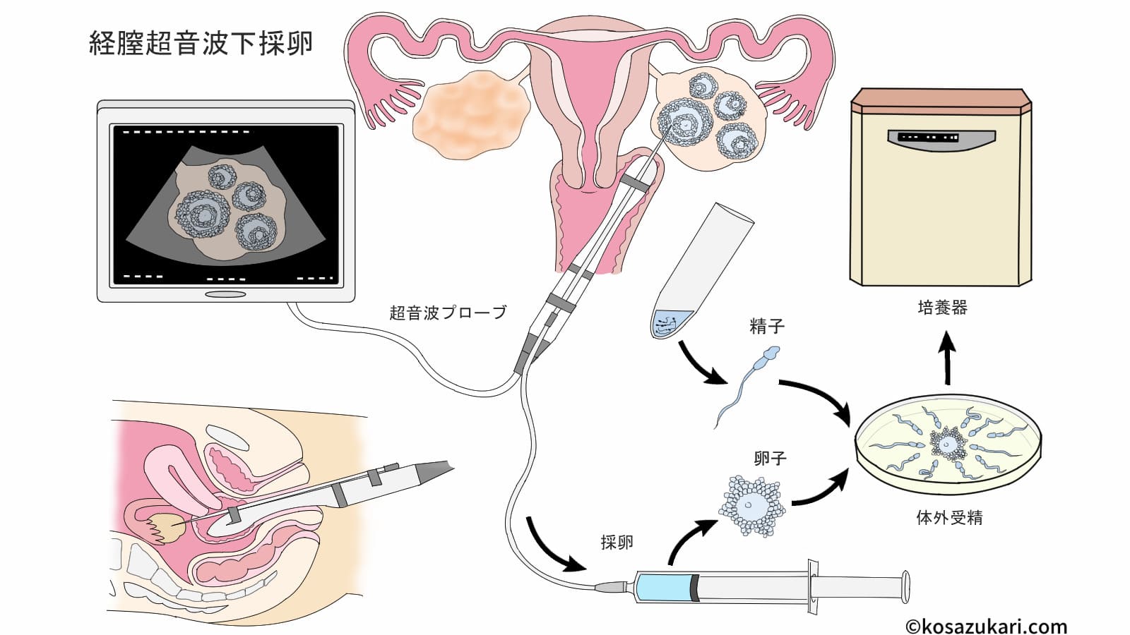 人工授精で女の子は産み分け可能？成功確率の真相と2026年最新事情