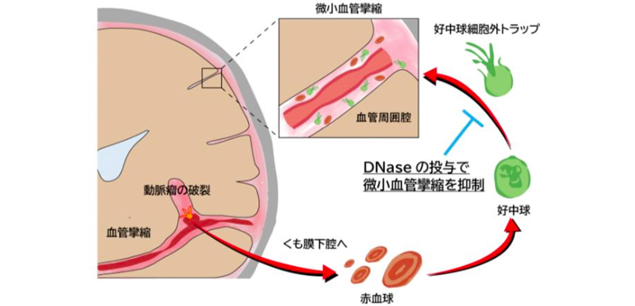 くも膜下出血の難関「脳血管攣縮」とは？発症ピークと最新治療の全貌