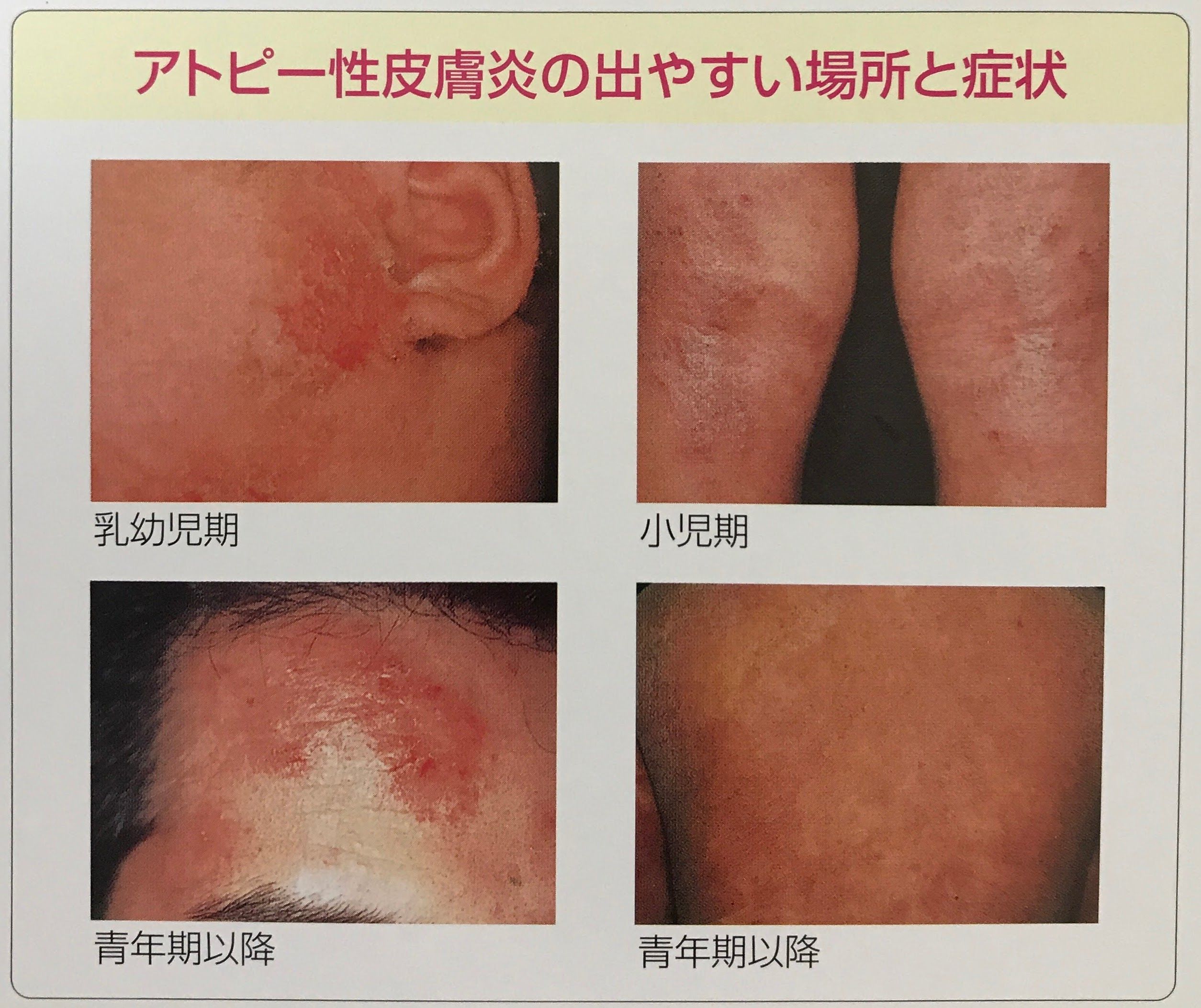 アトピー色素沈着を消す方法！皮膚科治療と美白ケア期間【2026】