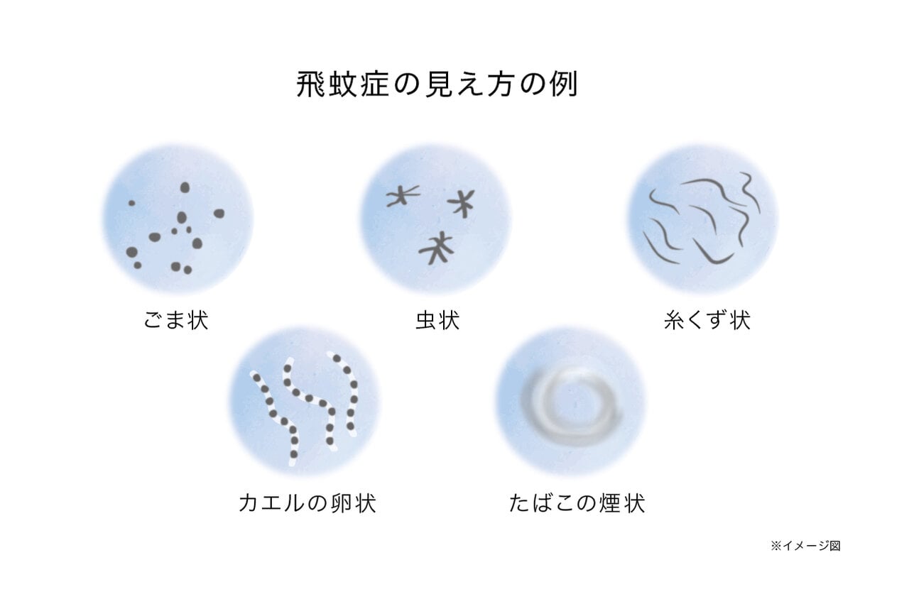 目に黒い点が見える原因とは？網膜剥離の前兆と緊急受診の判断基準