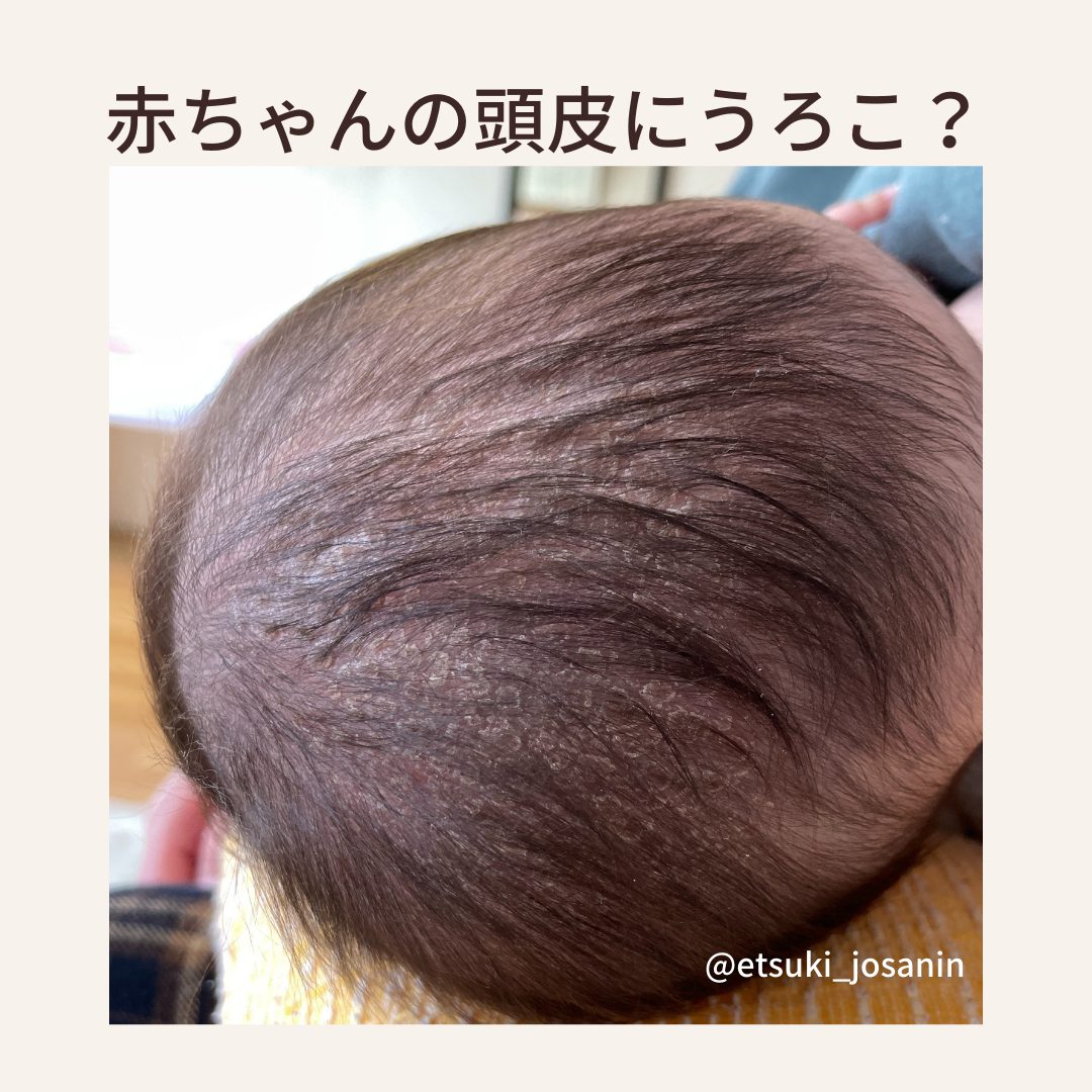 赤ちゃんの頭皮が剥ける原因は？フケ・かさぶたの正しいケアと受診目安