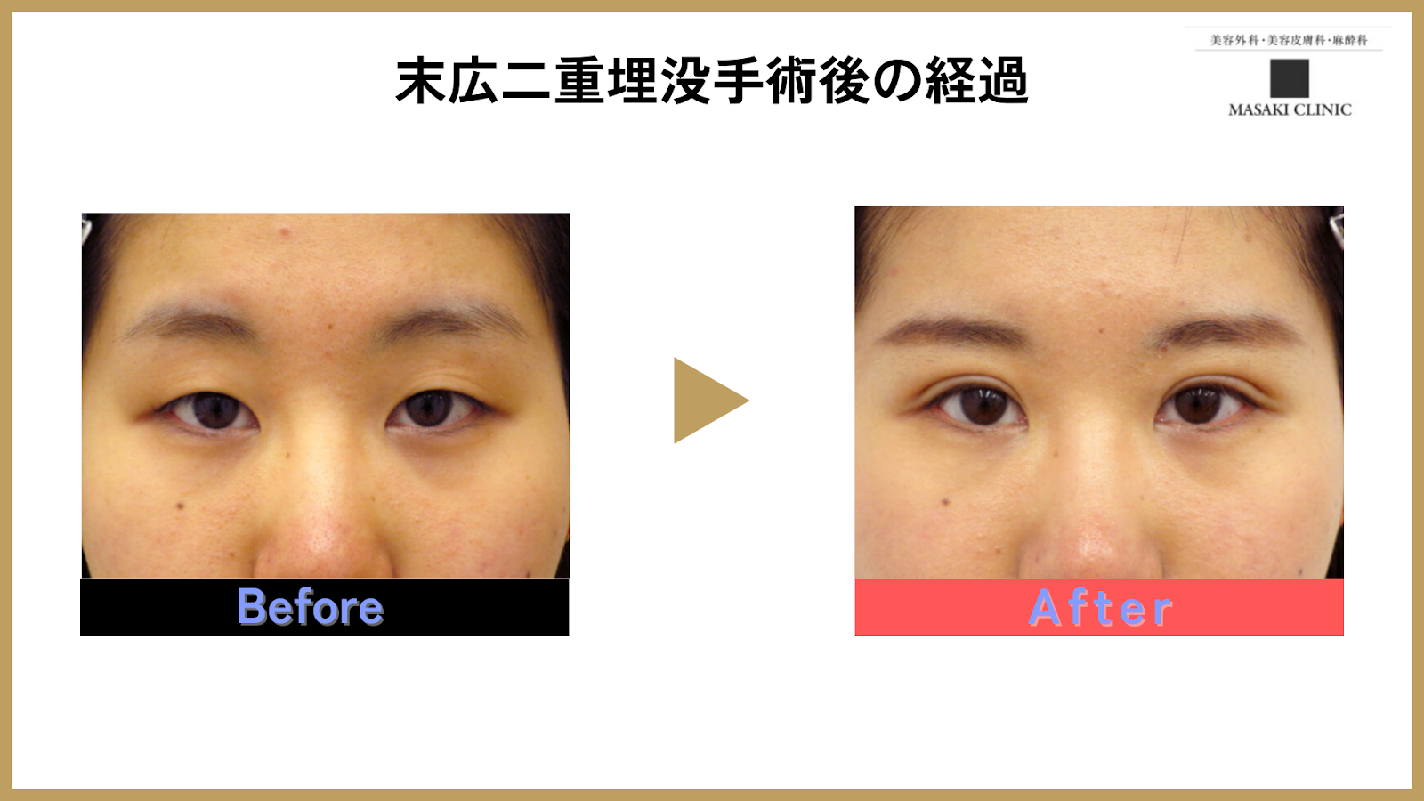 末広二重が愛される理由とは？平行型との違いや似合う人の特徴を徹底解明