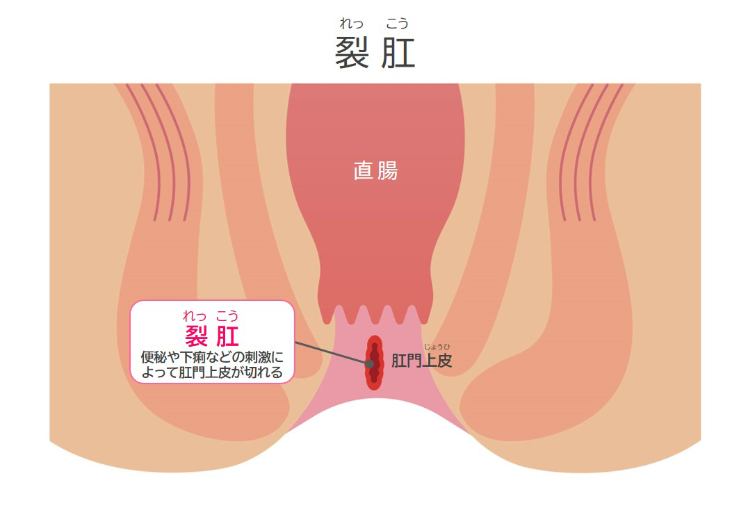お尻の穴が痛い原因、痔以外に潜む危険な病気を徹底解説