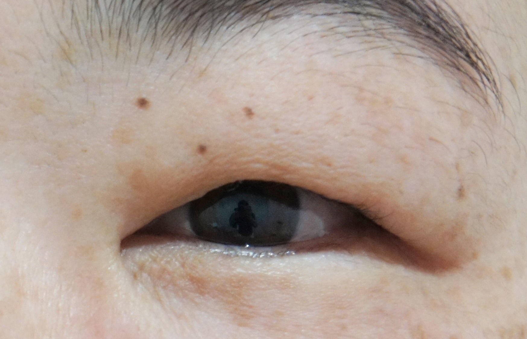まぶたの脂肪取りは自力で可能？噂の真相と2026年最新の対策