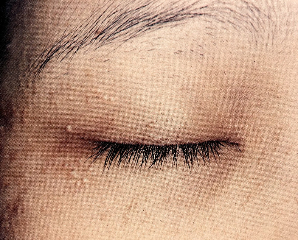 目の周りのプツプツの正体は？稗粒腫・汗管腫の原因と治療法2026