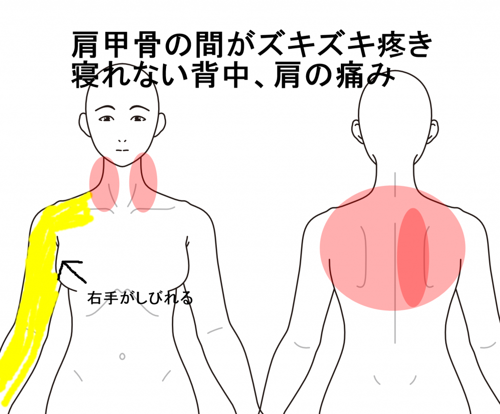 肩甲骨の間が痛いのは病気のサイン？危険度の見分け方と改善法
