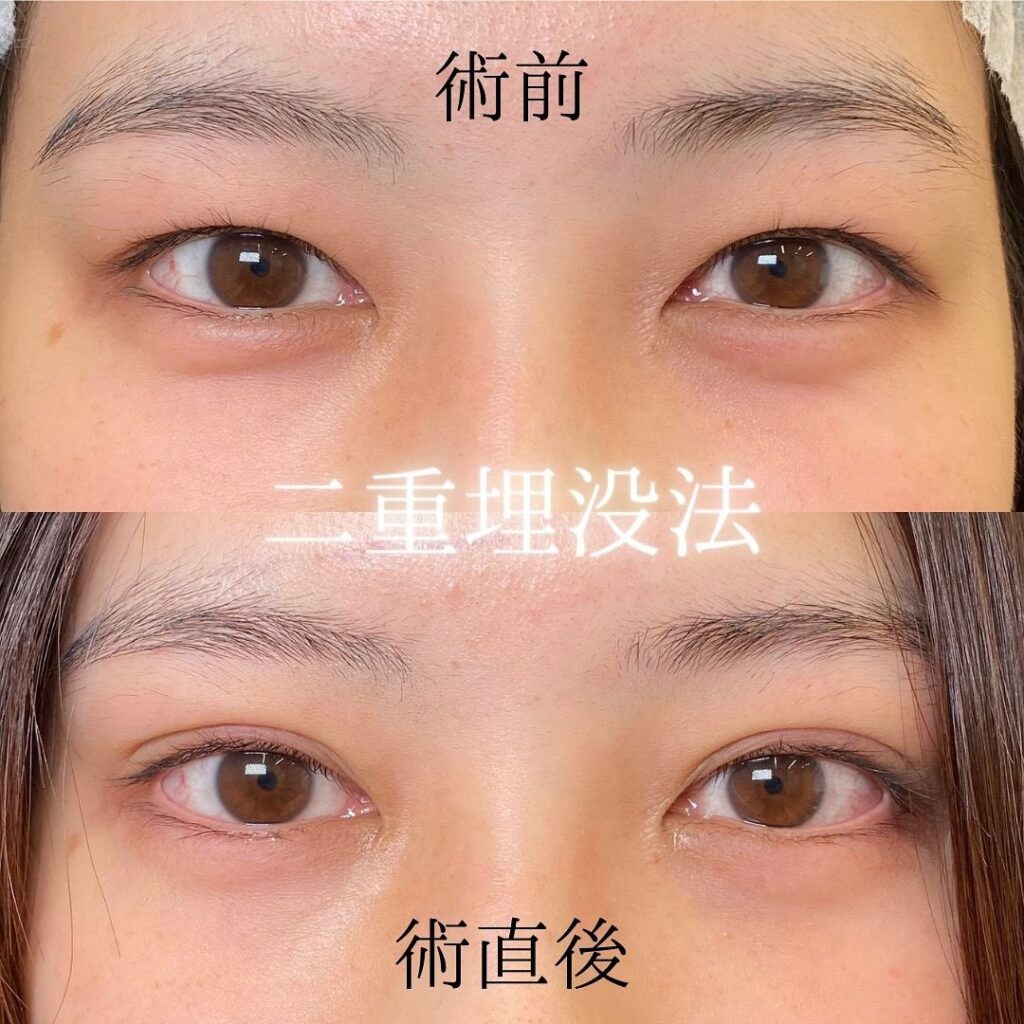 二重幅が広すぎて変？不自然なハム目の原因と2026年最新の修正術