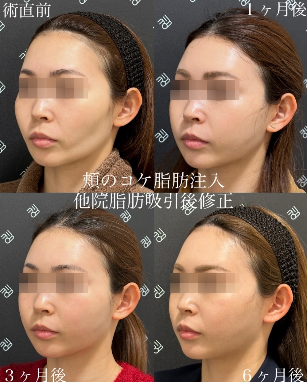 急な頬のこけはなぜ？老け見えNg習慣の真相と若返り改善法を徹底解説