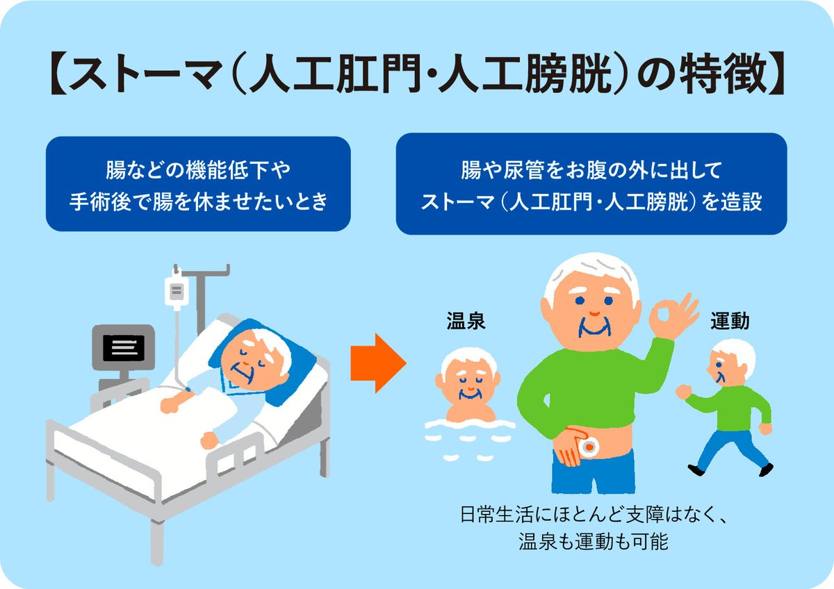 人工膀胱と膀胱瘻の違いとは？手術や管理・生活の決定的な差を徹底解説！