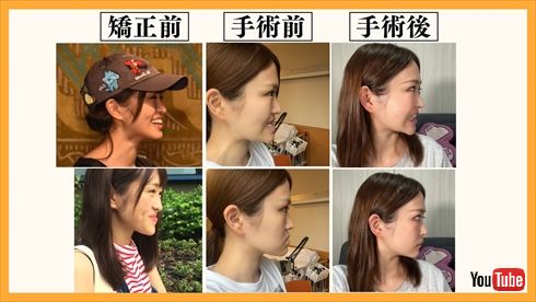 【2026最新】 顎 変形 症 手術 芸能人 公式インスタ・X最新情報 #895