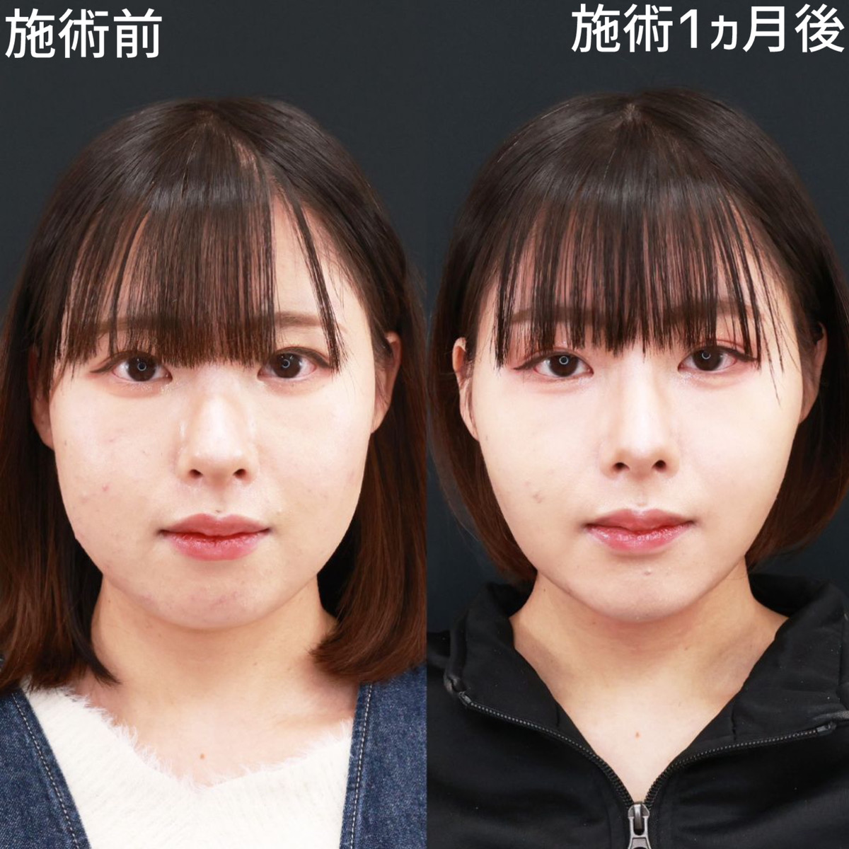 痩せたら鼻は小さくなる？団子鼻の変化と脂肪が落ちる限界を徹底検証