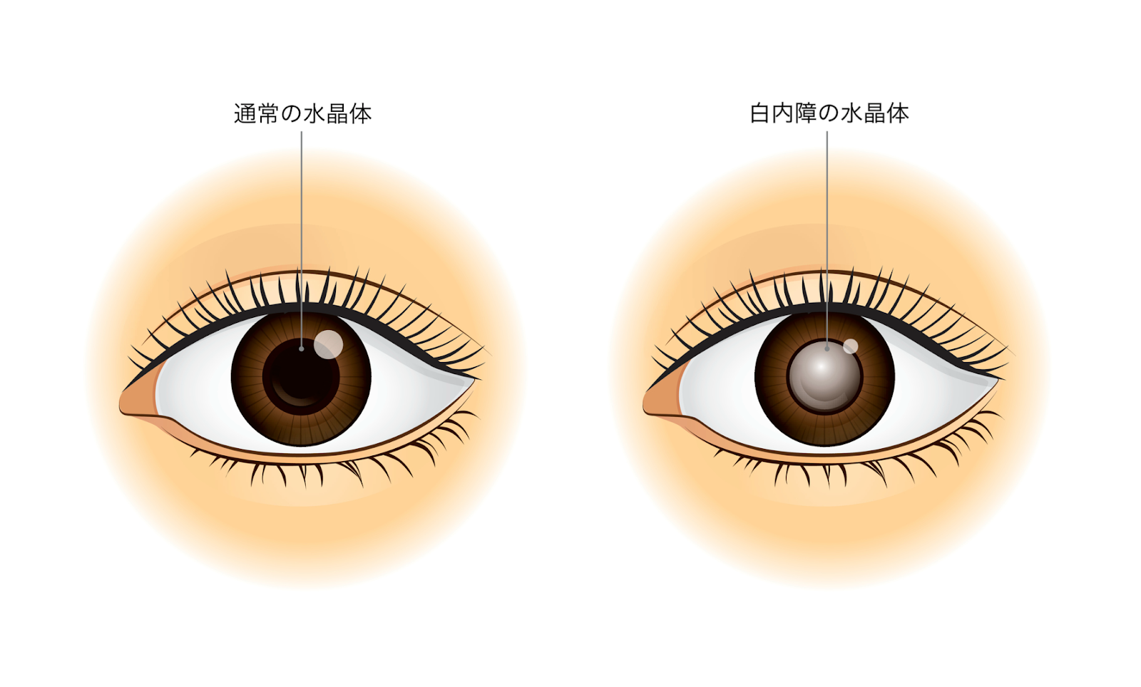 目がまぶしい病気の見分け方と受診目安｜失明や脳の異変を防ぐ警告サイン