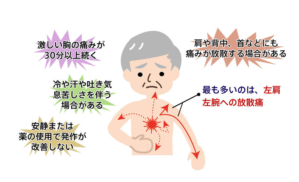 心筋梗塞の肩の痛みはどんな痛み？肩こりと違う前兆サインと受診基準