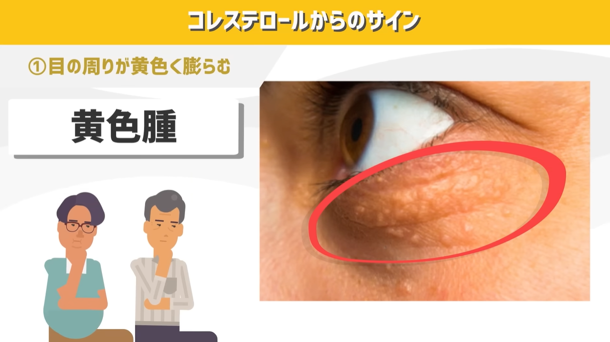 コレステロールが高いと出る症状は？見逃せない危険サインと最新基準