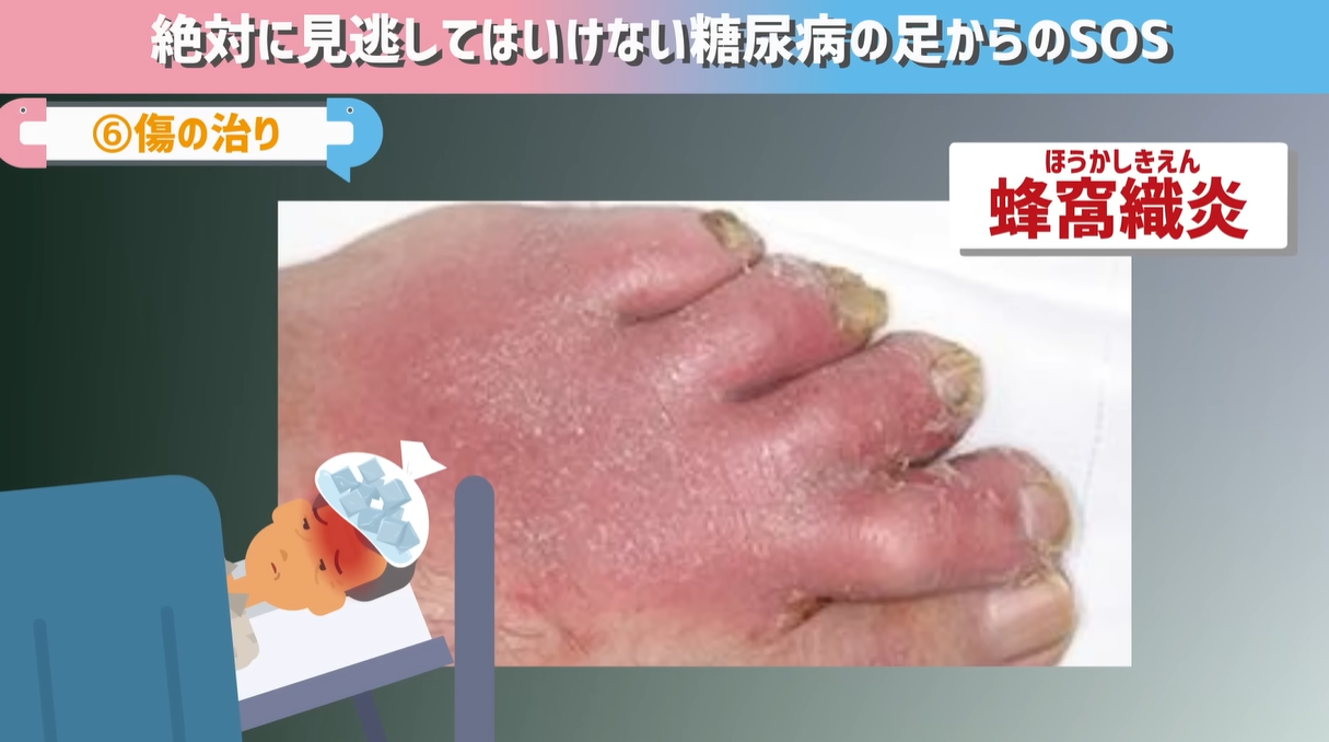 足の指の痒みは糖尿病のサイン？水虫との見分け方と壊疽を防ぐ対処法