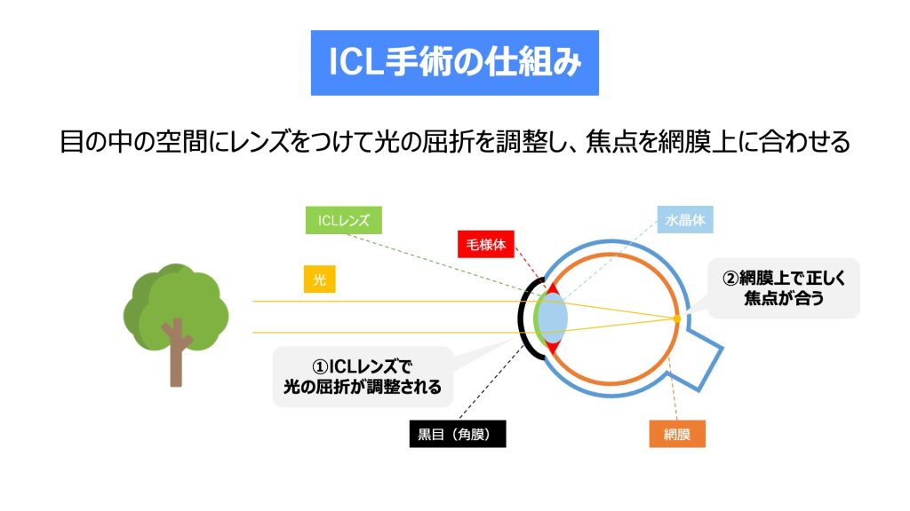 Icl手術の失敗例と後悔の実態｜失明リスクの真相と後遺症を徹底検証