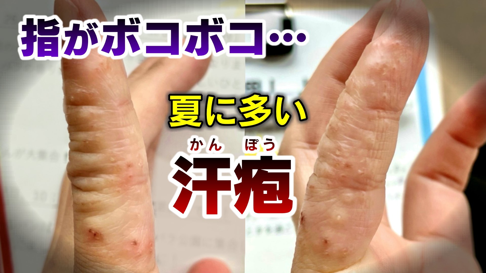 指先のブツブツやかゆみの正体とは？汗疱の治し方と放置厳禁の理由を解説