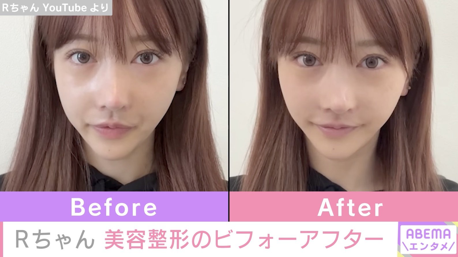 Rちゃんの整形前はどんな顔？総額3000万円の変遷と素顔の全貌