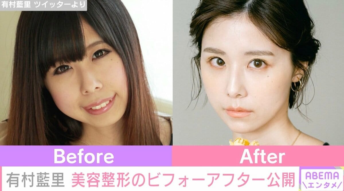 有村藍里の整形告白から現在｜骨切りの費用や妹架純との絆を追う