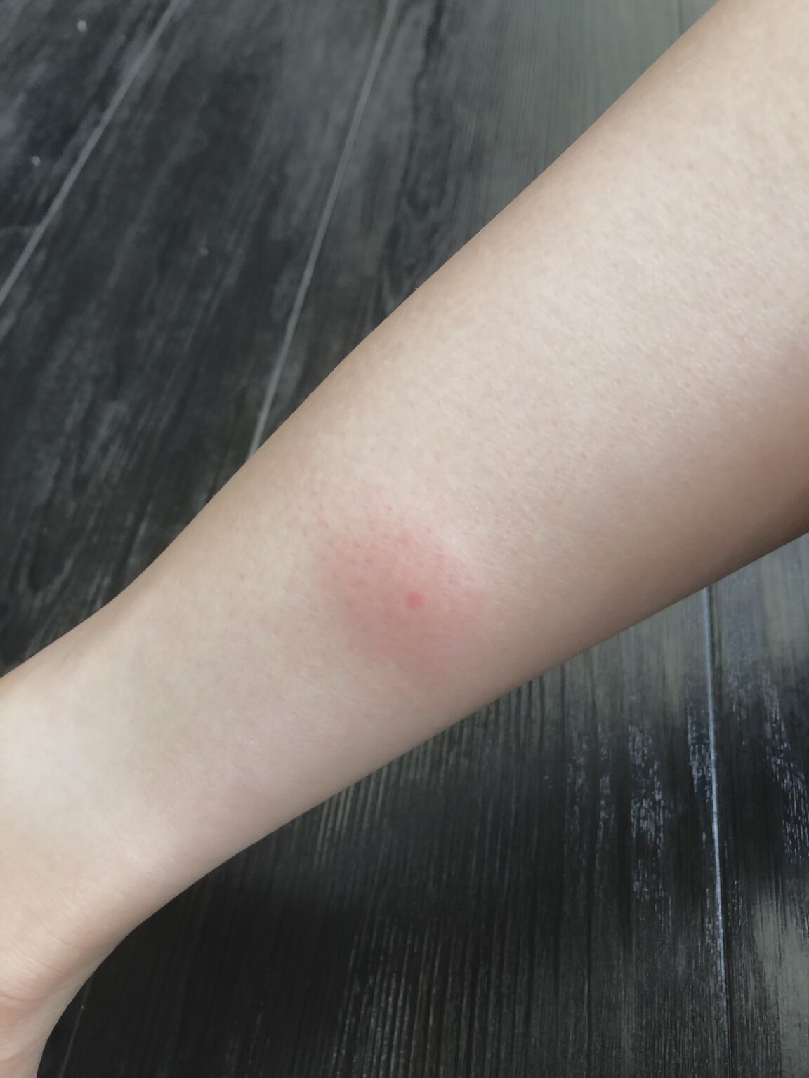 アブに刺された時の応急処置と薬！激痛・腫れの対処と跡を残さない全知識