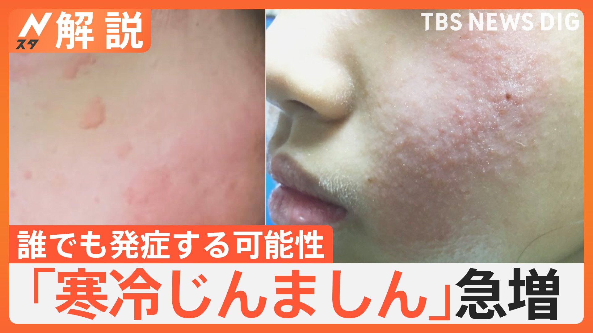 寒冷蕁麻疹はなぜ突然出る？原因・治し方と危険なサインを徹底解説