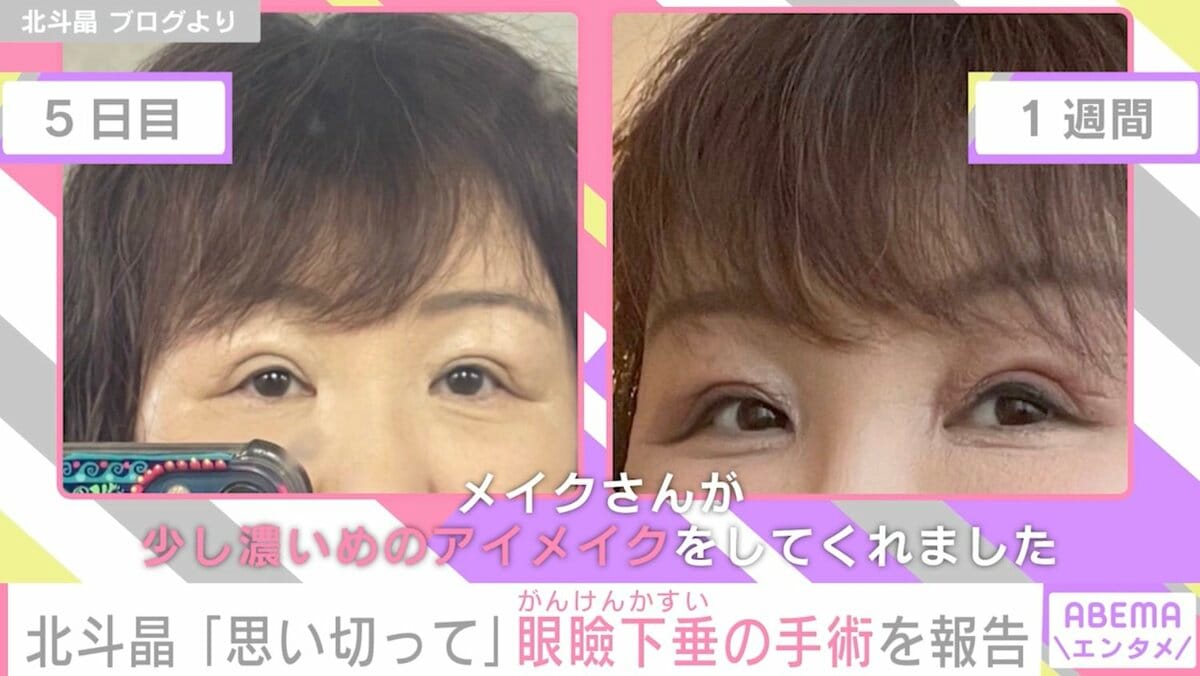 眼瞼下垂手術で顔が変わった芸能人の真相｜失敗と噂された原因と現在