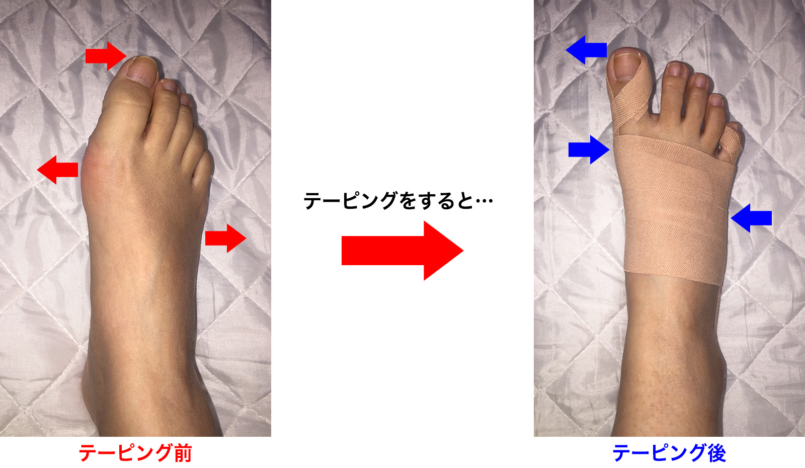 外反母趾テーピングの巻き方決定版！プロ直伝の簡単手順と痛み軽減術