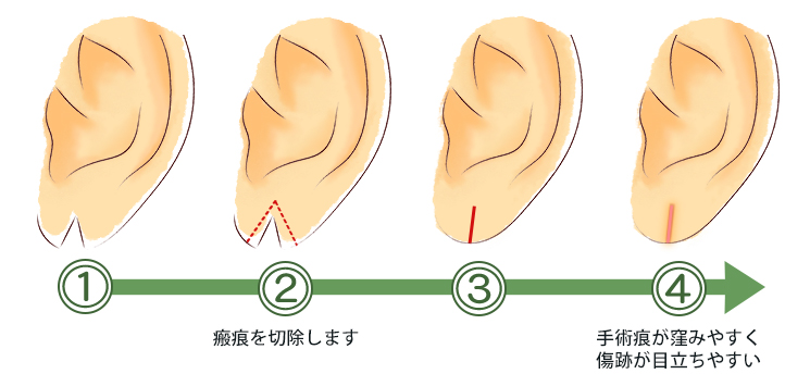 耳たぶやリンパの腫れとしこり！痛い原因と何科を受診すべきか徹底解説